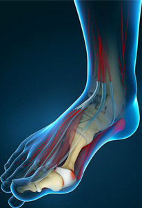 Bunions (Hallux Valgus)
