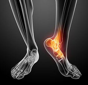 Achilles Tendinitis